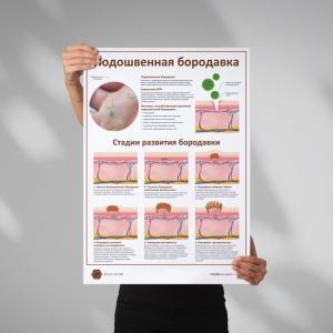 Фото - Подошвенная бородавка (плакат А1)