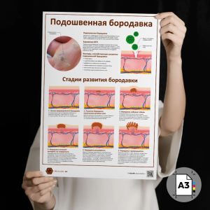 Фото - Подошвенная бородавка (плакат А3)