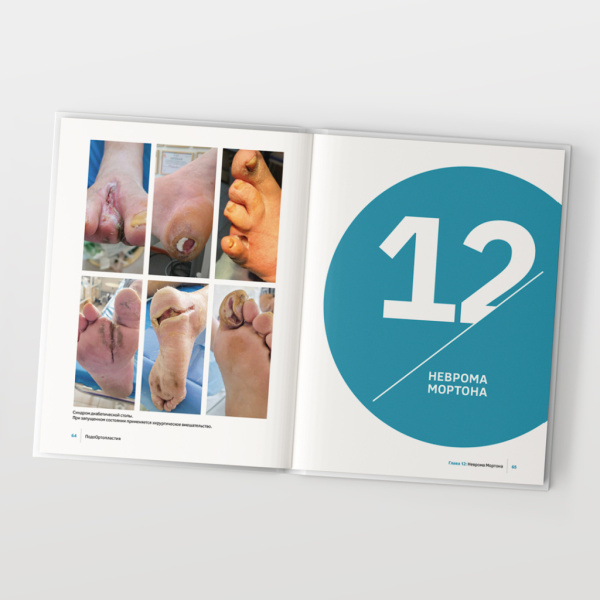 Фото - ПодоОртопластия. Ортопластия и малая ортопедия для спецов и не только…