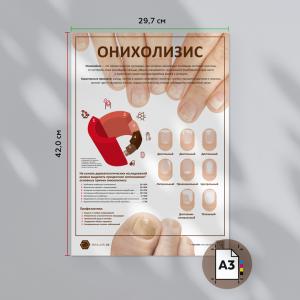 Фото - Онихолизис (плакат А3)