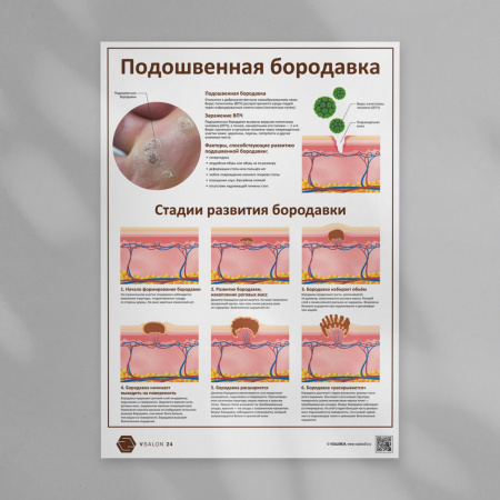 Фото - Подошвенная бородавка (плакат А1)