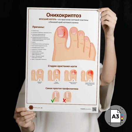 Фото - Онихокриптоз (плакат А3)