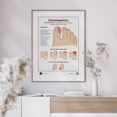 Фото - Онихокриптоз (плакат А1)