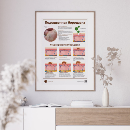 Фото - Подошвенная бородавка (плакат А1)